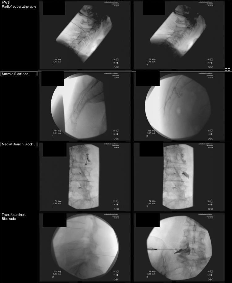 HWS Radiofrequenztherapie dc Sacrale Blockade Medial Branch Block Transforaminale  Blockade